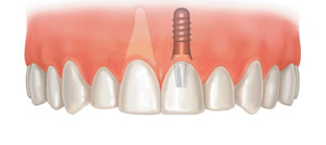 Tooth Implant