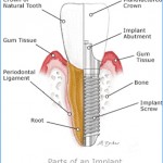 tooth implant inside view