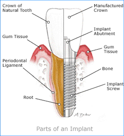 tooth implant inside view
