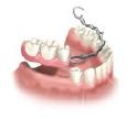 Removable Partial Dentures